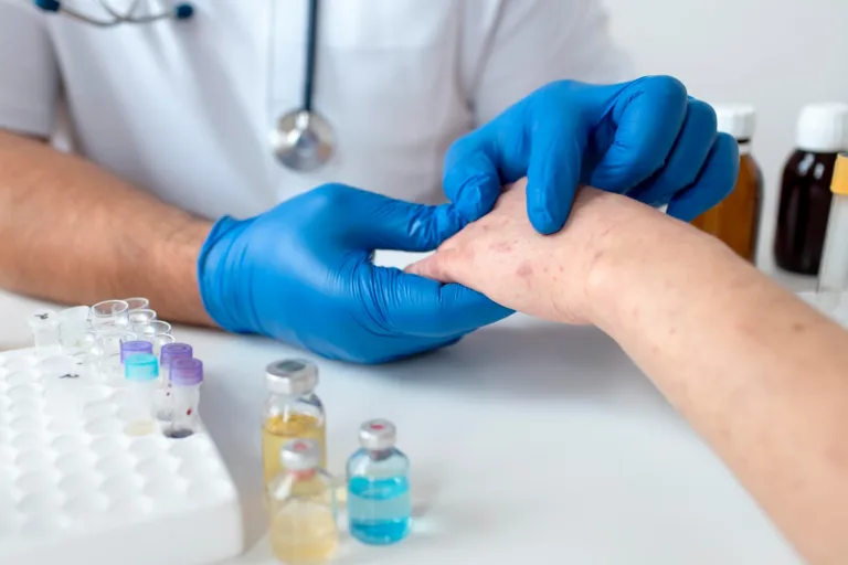 Union study for oral orismilast yields positive results in hidradenitis suppurativa patients