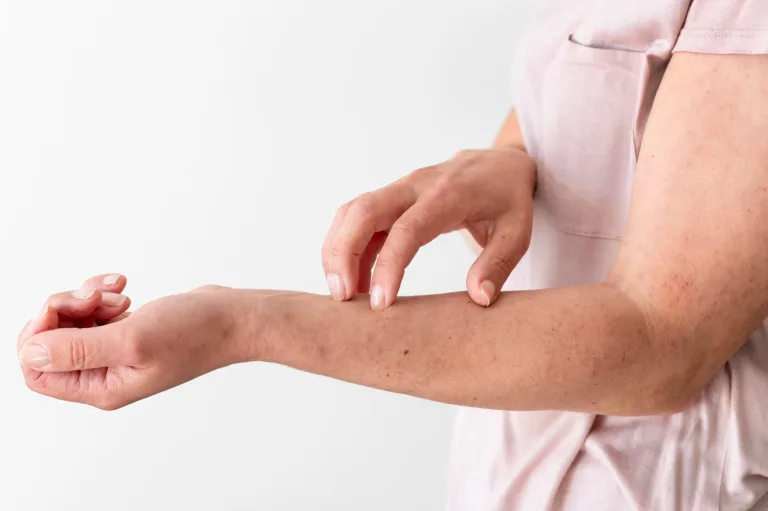 Bristol Myers Squibb Launches Sotyktu Initiative to Provide a ‘Comprehensive Insight’ into Living with Psoriasis