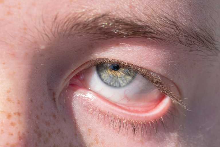 FDA Gives Reproxalap the Red Light For Dry Eye Disease